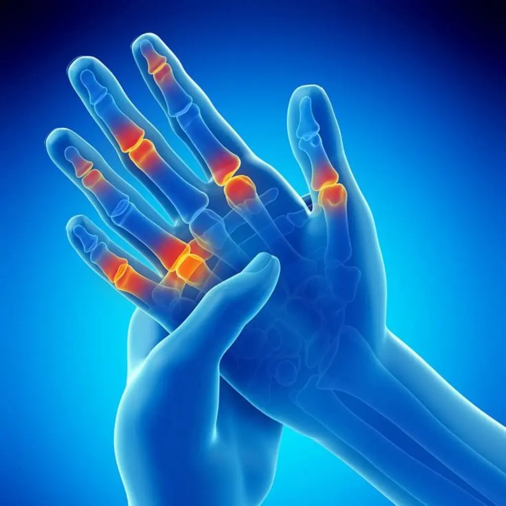 Illustration of painful hand joints affected by arthritis