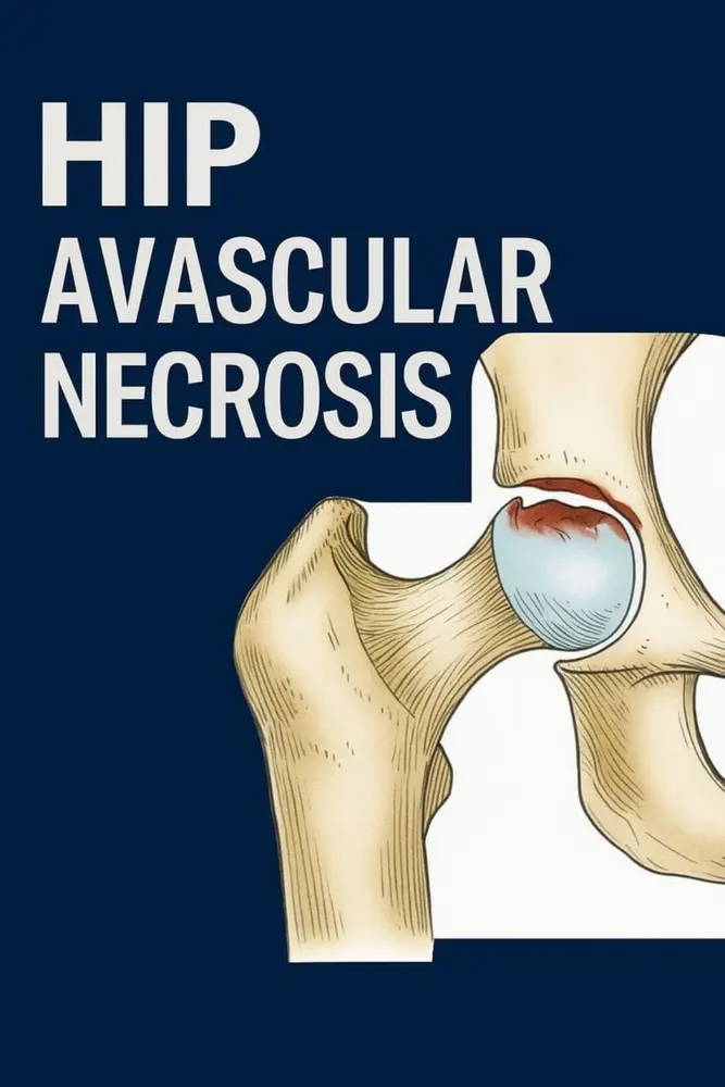 Illustration of avascular necrosis affecting the hip joint