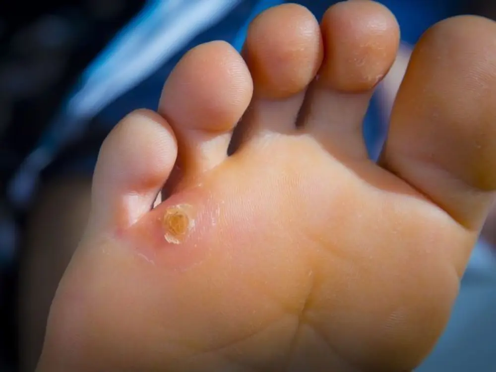 Photograph of a pressure-related corn on the sole