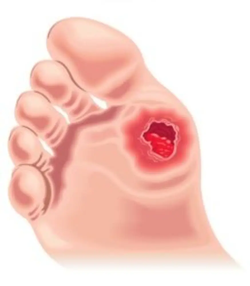 Illustration of a diabetic foot ulcer requiring wound assessment