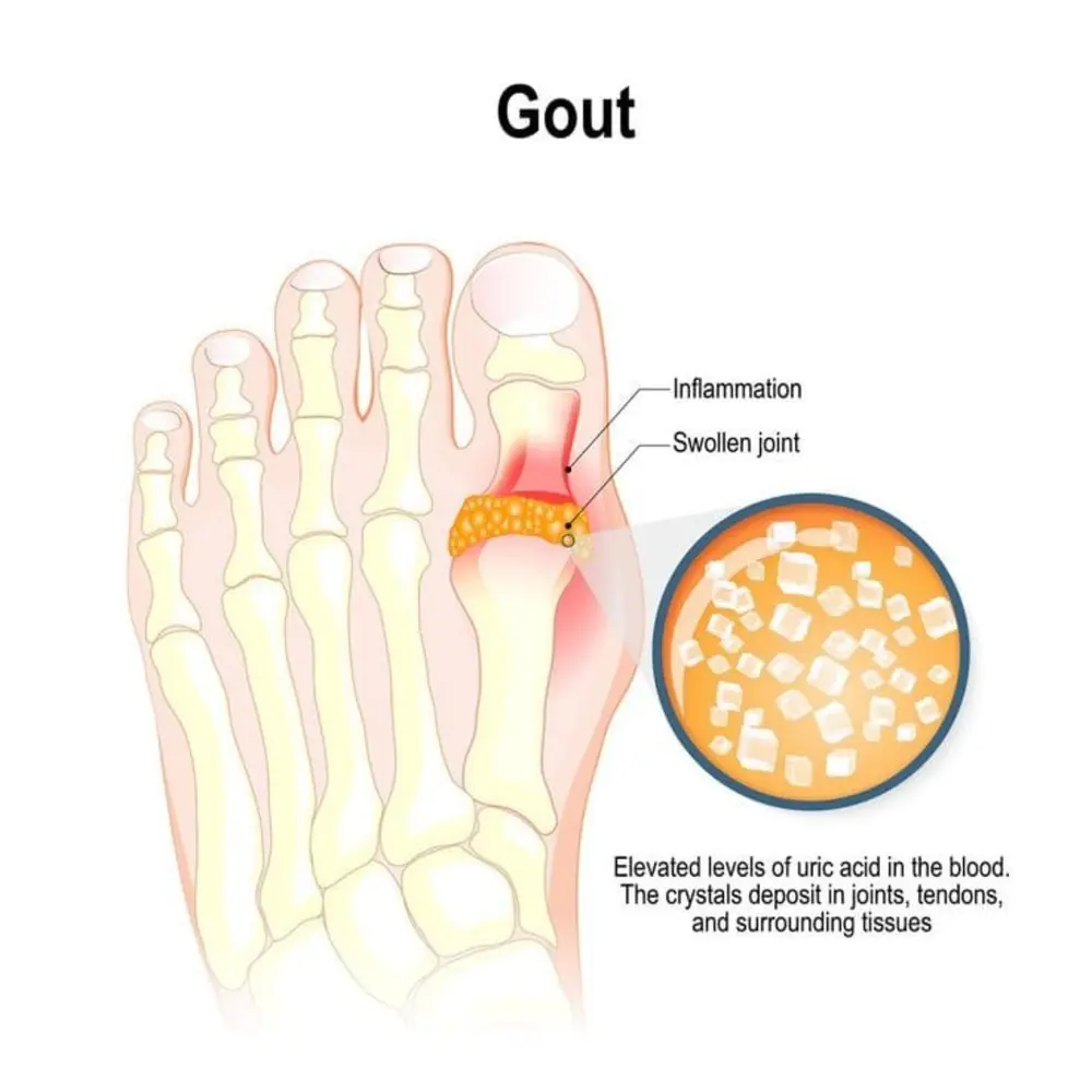 Illustration of gout affecting the great-toe joint