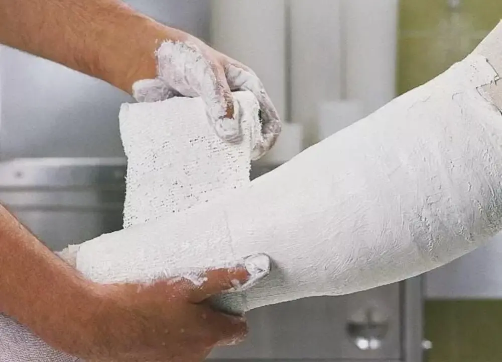 Orthopedic plaster cast application
