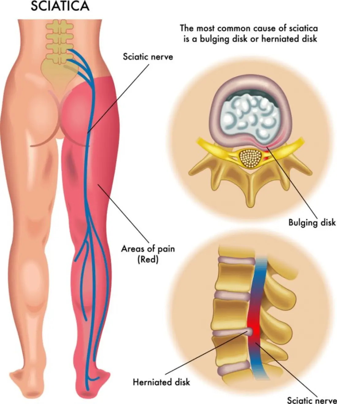 Illustration showing the sciatic nerve and common pattern of sciatica