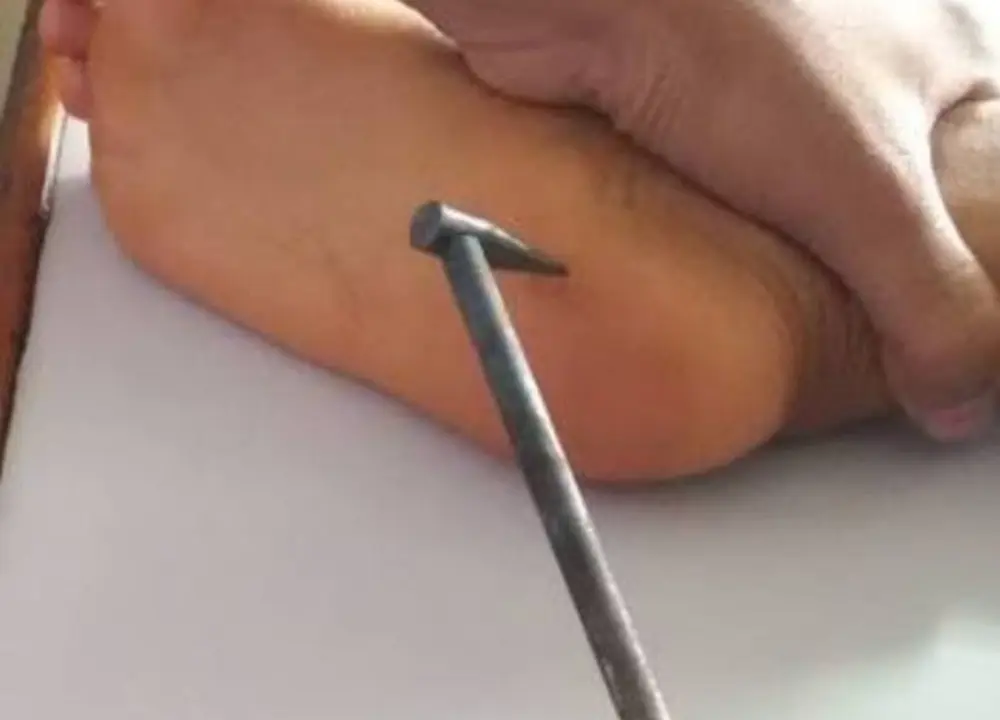 Agnikarma procedure being performed for a selected heel condition